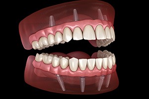 a model of a mouth with a denture on top of it