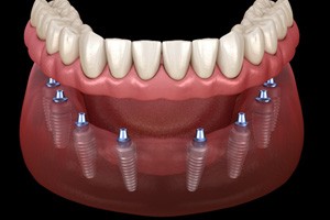a computer illustration depicting implant dentures