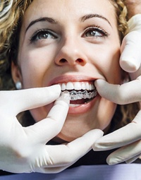 a dentist putting a pair of Invisalign trays on a patient to see if they fit properly